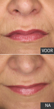 Botox-fillers-boxmeer-nijmegen-lippen-03